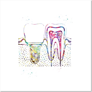 Human teeth and dental implant Posters and Art